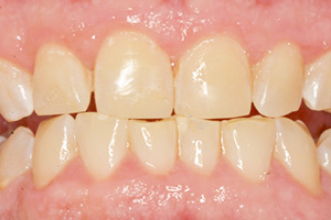The image shows a close-up view of a person s teeth with yellow staining, set against a grey background.