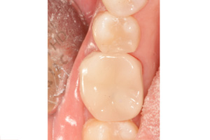 This is a close-up photograph of an open mouth with a dental implant and surrounding tissue.