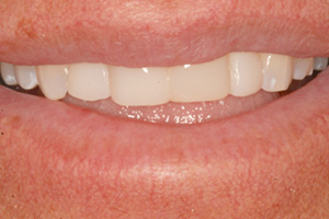 The image displays a close-up of an individual s smiling face with teeth, showing a wide smile, against a neutral background.