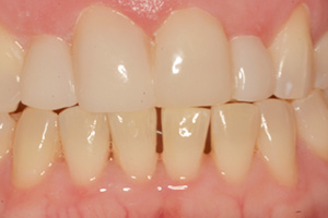 The image shows a close-up view of a person s teeth with a focus on a yellowish discoloration, possibly indicating a need for dental care or cosmetic enhancement.