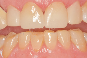 The image shows a close-up view of an open mouth with yellowed teeth and gums, which suggests dental neglect or poor oral hygiene.