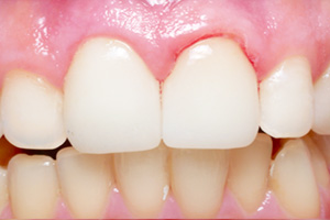 The image shows a close-up of a person s teeth with a focus on a tooth that appears to be undergoing dental treatment, likely a cleaning or polishing process.