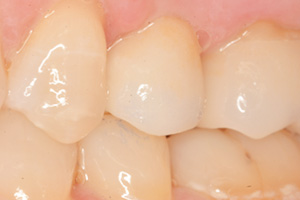The image displays a close-up view of a person s teeth with visible staining, suggesting poor oral hygiene or dental health issues.