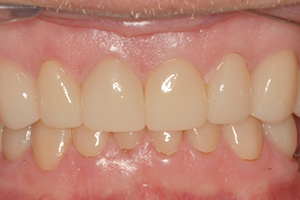 The image shows three photographs of a person s teeth before and after dental treatment, highlighting the transformation from yellowed to clean and white teeth.