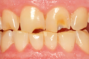 The image shows a close-up of a person s mouth with teeth, where some teeth are yellowed and others have discoloration, possibly due to decay or staining.