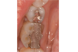The image shows an open mouth with dental implants and gold crowns, featuring a close-up view of teeth and gums.