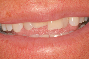 The image displays a close-up view of a person s mouth with teeth showing, and there is visible decay on the front teeth.