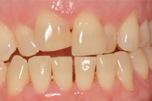The image shows two close-up photographs of a person s teeth with visible decay and discoloration, highlighting dental health issues.
