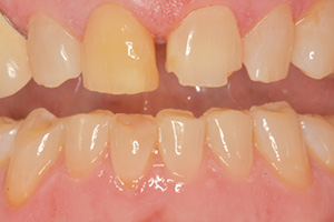 The image shows a close-up view of a person s mouth with teeth that appear to be decayed or damaged, and the gums are inflamed, suggesting poor oral hygiene or dental health issues.