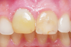 The image shows a close-up view of a person s mouth with a focus on a tooth that has been restored or repaired, likely indicating dental work such as a filling or crown, set against a background with a pinkish hue, possibly due to the presence of a substance like a topical anesthetic.