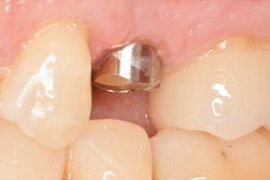 The image shows a close-up view of an open mouth with a single tooth being replaced by a silver filling, set against a pink background that could be a tongue or gum tissue.