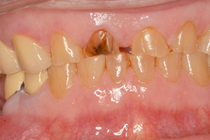 An extreme close-up of a person s mouth with yellow teeth, showing signs of decay and poor oral hygiene.